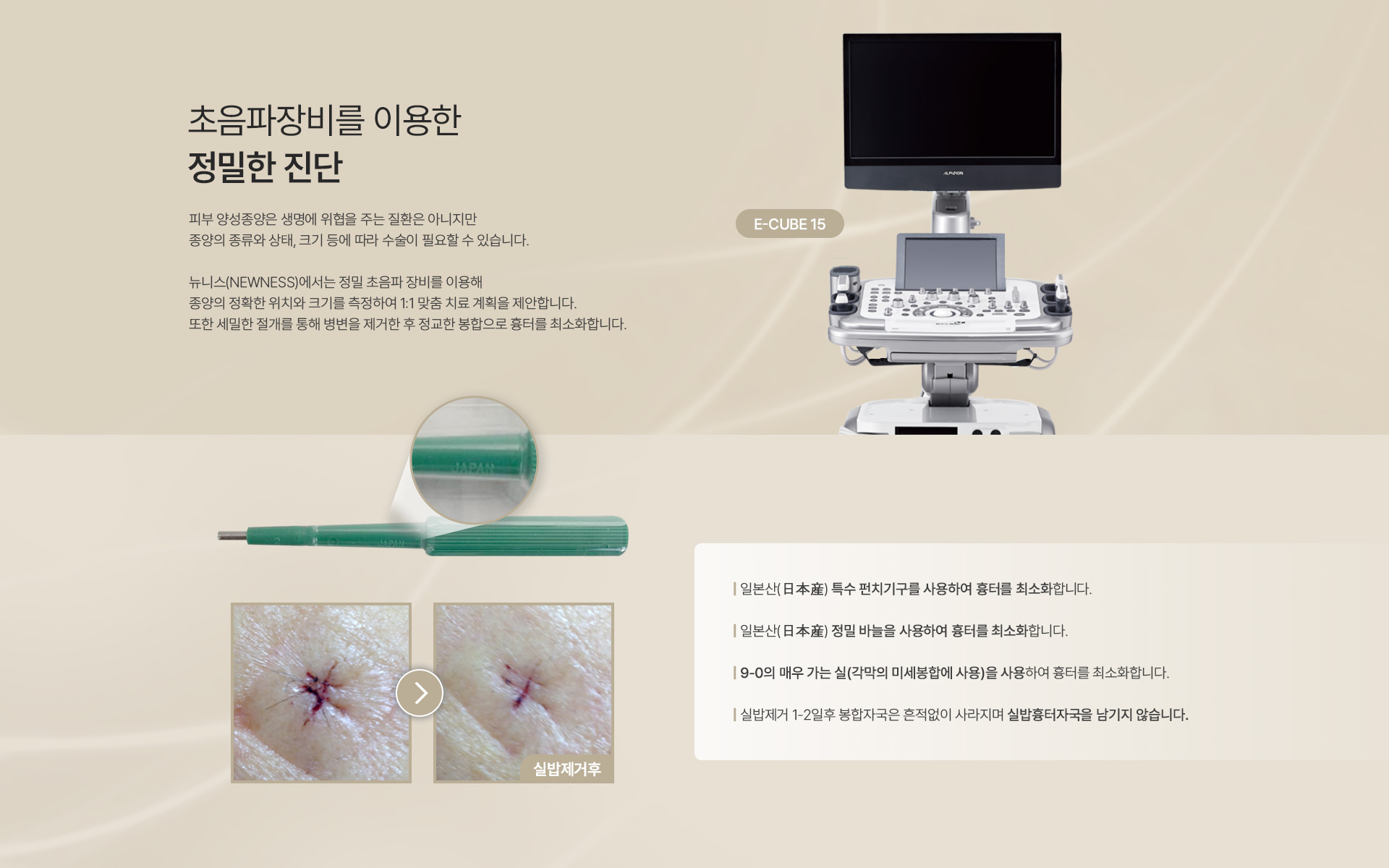 양성종양 정밀진단