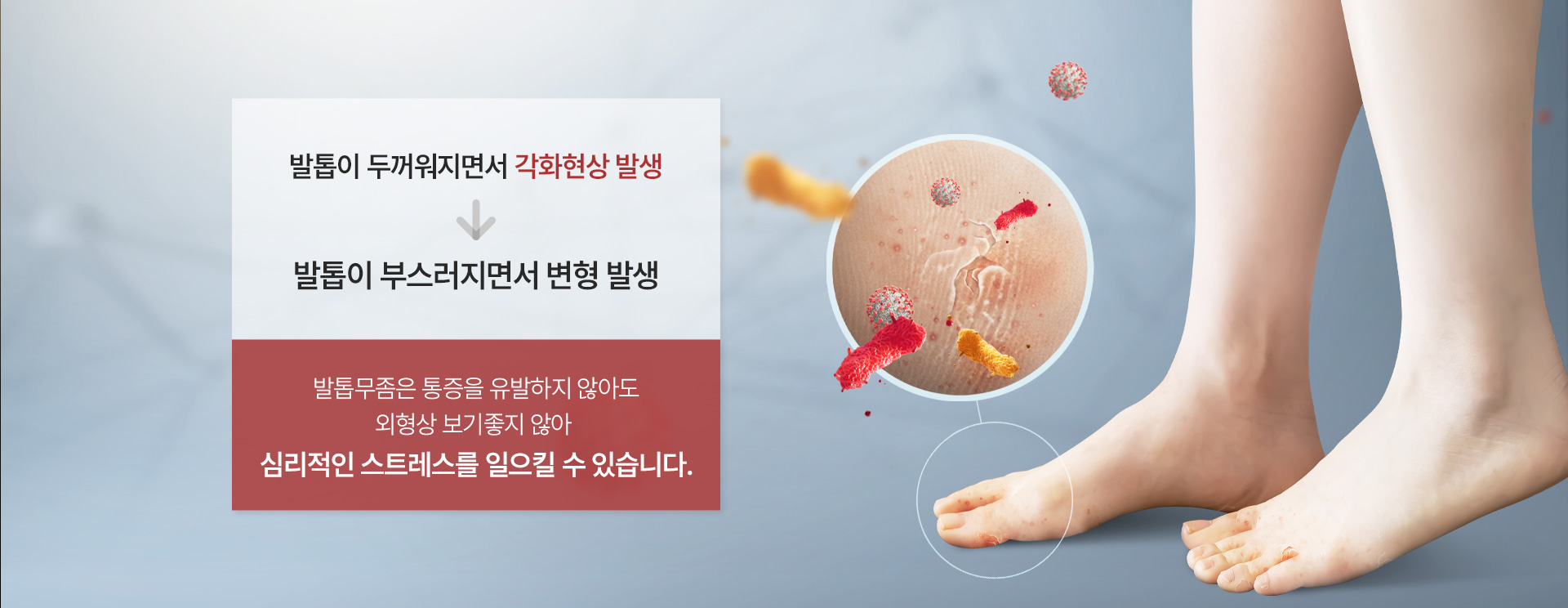 발톱무좀·내성발톱 스트레스