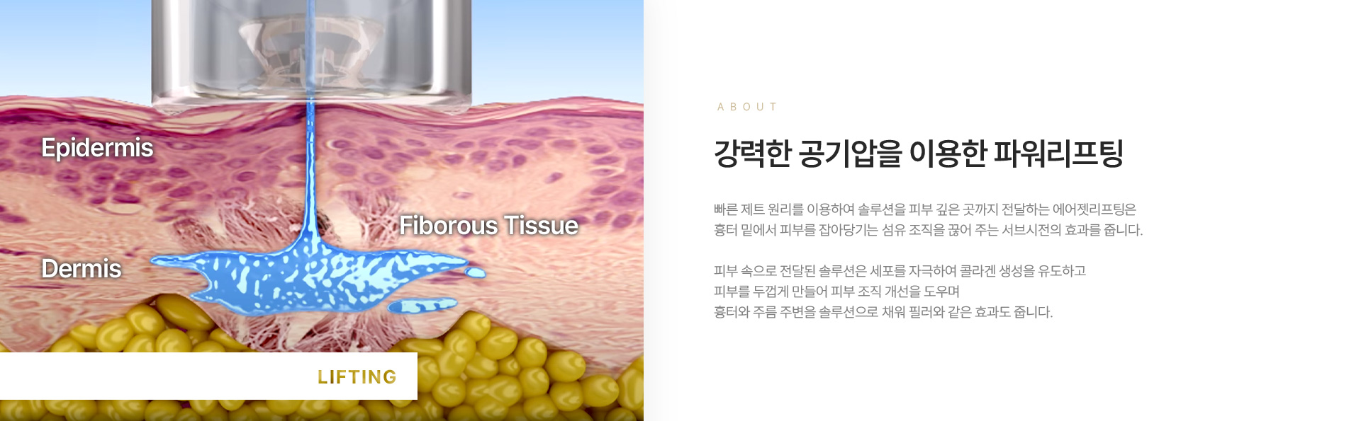 에어젯리프팅 설명