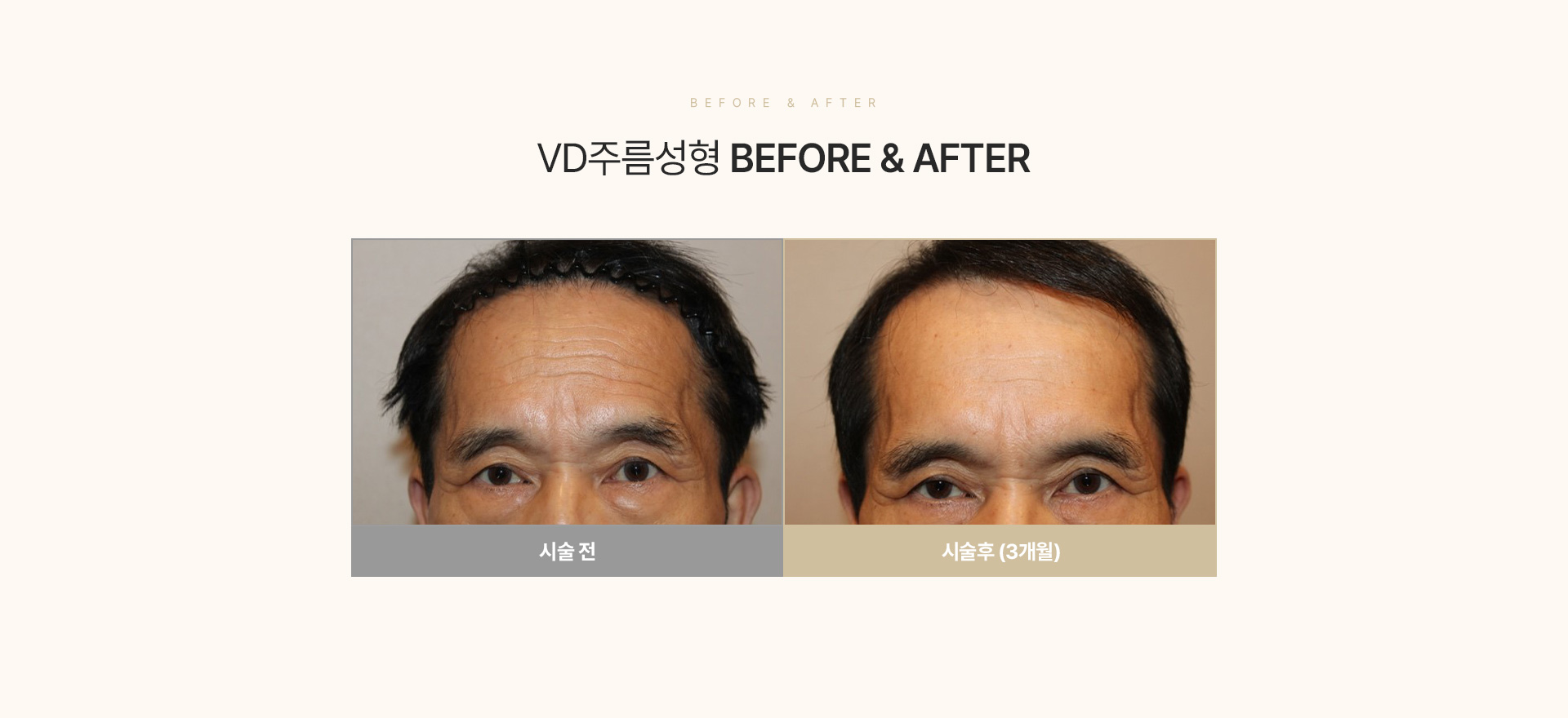 깊은주름·흉터VD성형술 비포애프터