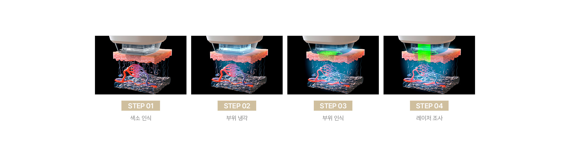 리팟레이저 이유